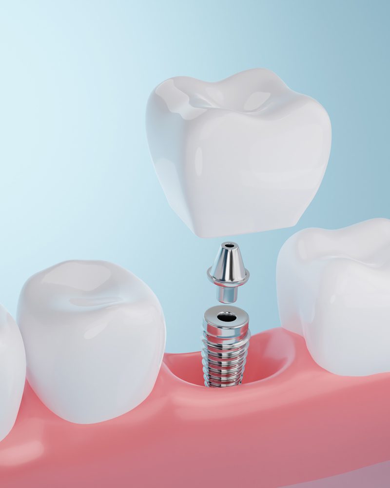 Dental Implants in Bowling Green, KY